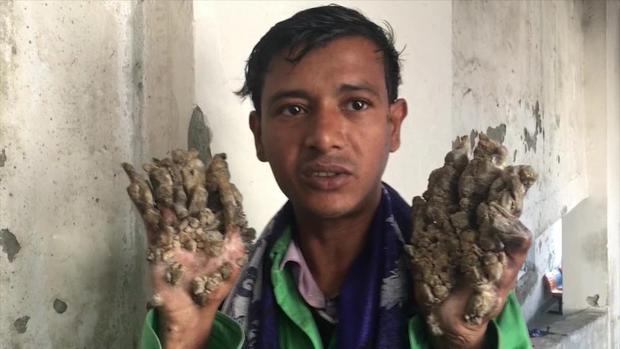 [TLMD - LV] El hombre árbol de Bangladesh vuelve al hospital sin esperanzas de curación