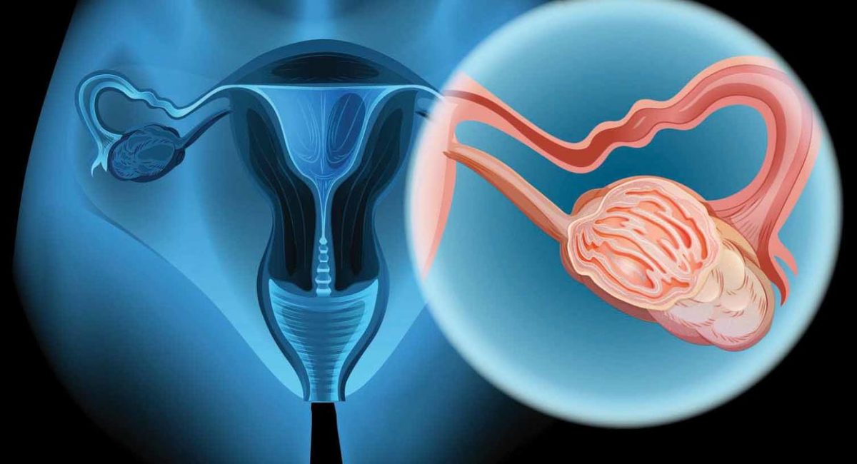 Cáncer de ovario: conoce sus síntomas