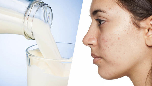 Investigadores: el acné y su vínculo con los lácteos