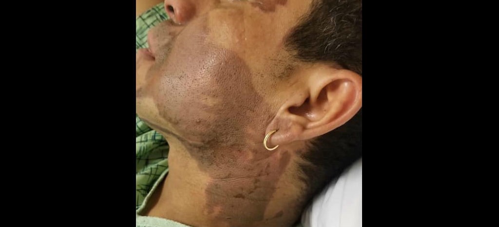 Arrestan al sospechoso de rociar ácido en la cara a un hombre de origen hispano en Milwaukee | Video