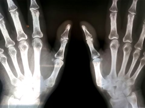 Radiografía de exploración ósea de rayos x de manos humanas
