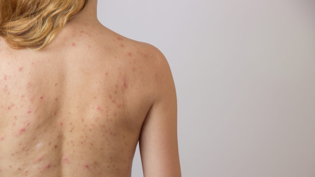 Cómo combatir el acné en la espalda con remedios caseros