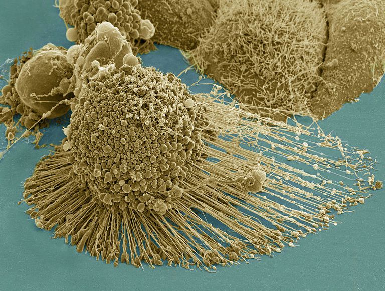 Células del cáncer vistas con microscopio electrónico.