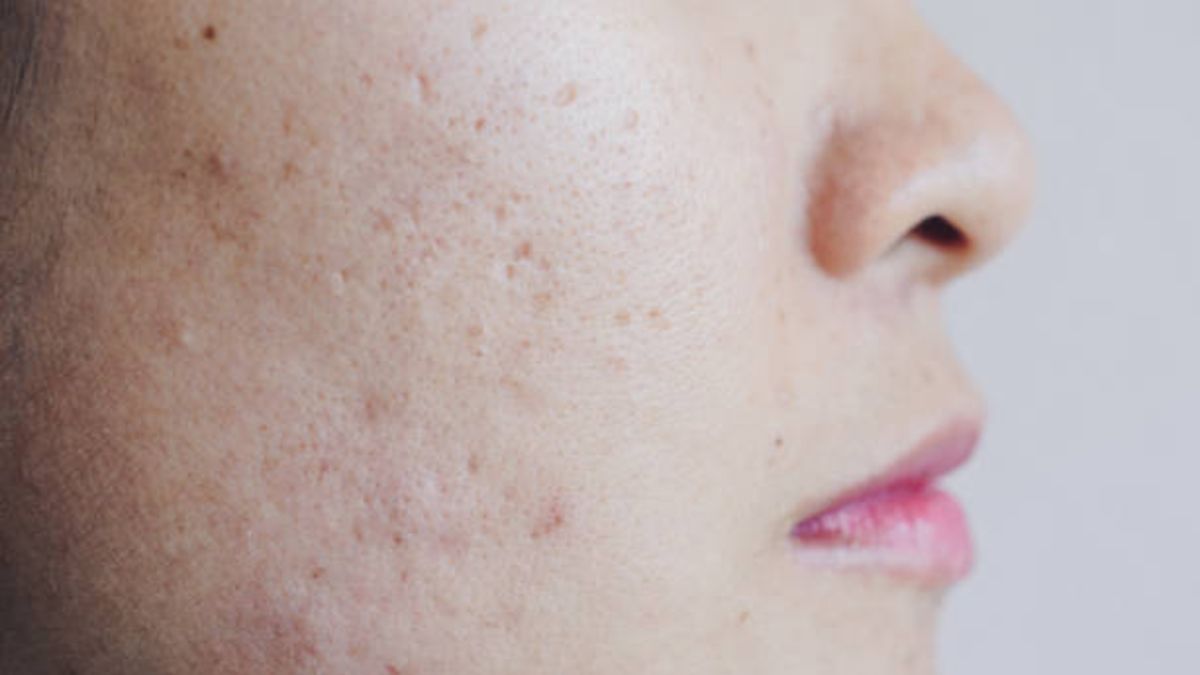 Tips y remedios para poder reducir los poros dilatados