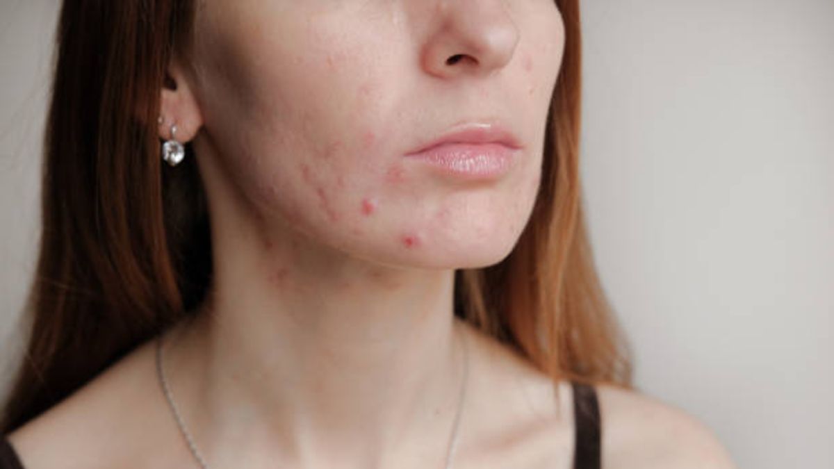 Tips y remedios para deshacerse de los granos de la cara