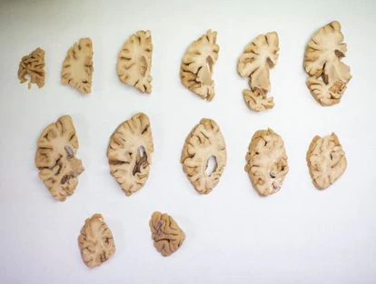 Un cerebro humano diseccionado en la Fundación CIEN, en Madrid.