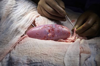 Un cirujano maneja el riñón de cerdo trasplantado a una mujer en muerte cerebral, el 25 de septiembre, en el Centro Médico Langone de la Universidad de Nueva York.