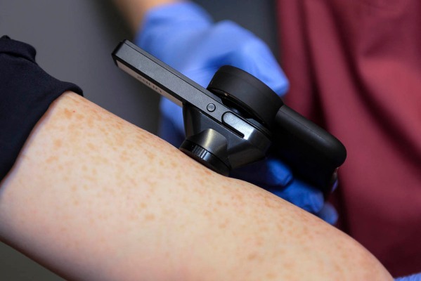 Skin Analytics recauda £ 4M Serie A para usar IA para la detección del cáncer de piel