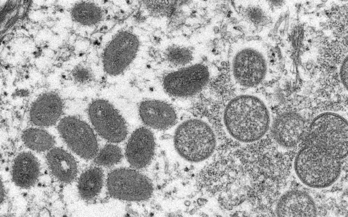 Nueva York detecta primer caso de viruela símica en niño