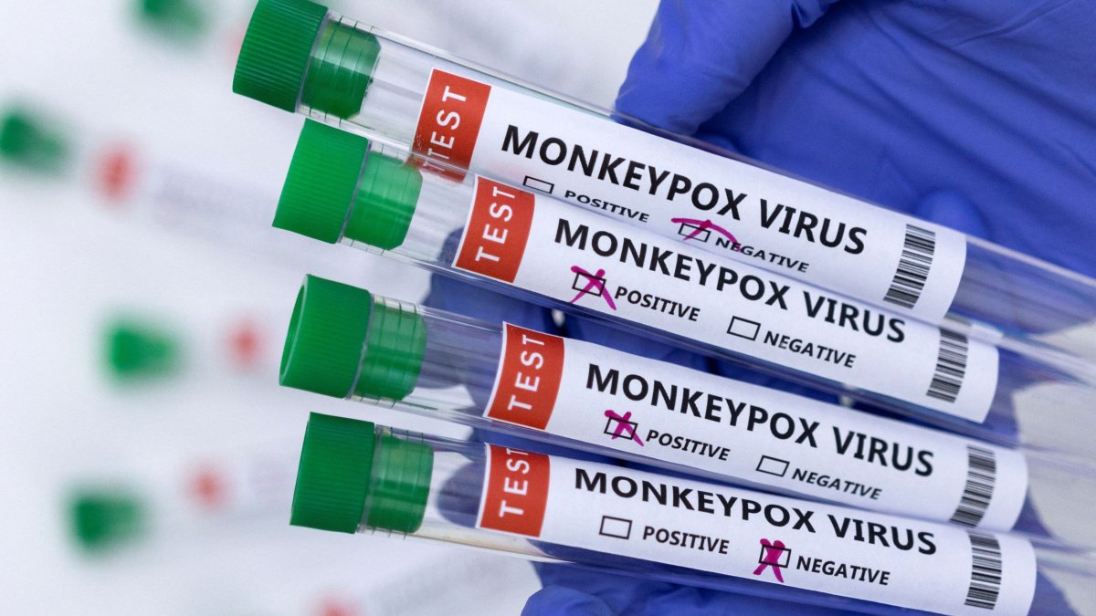 Identifican posible caso de viruela del mono en el condado de Riverside