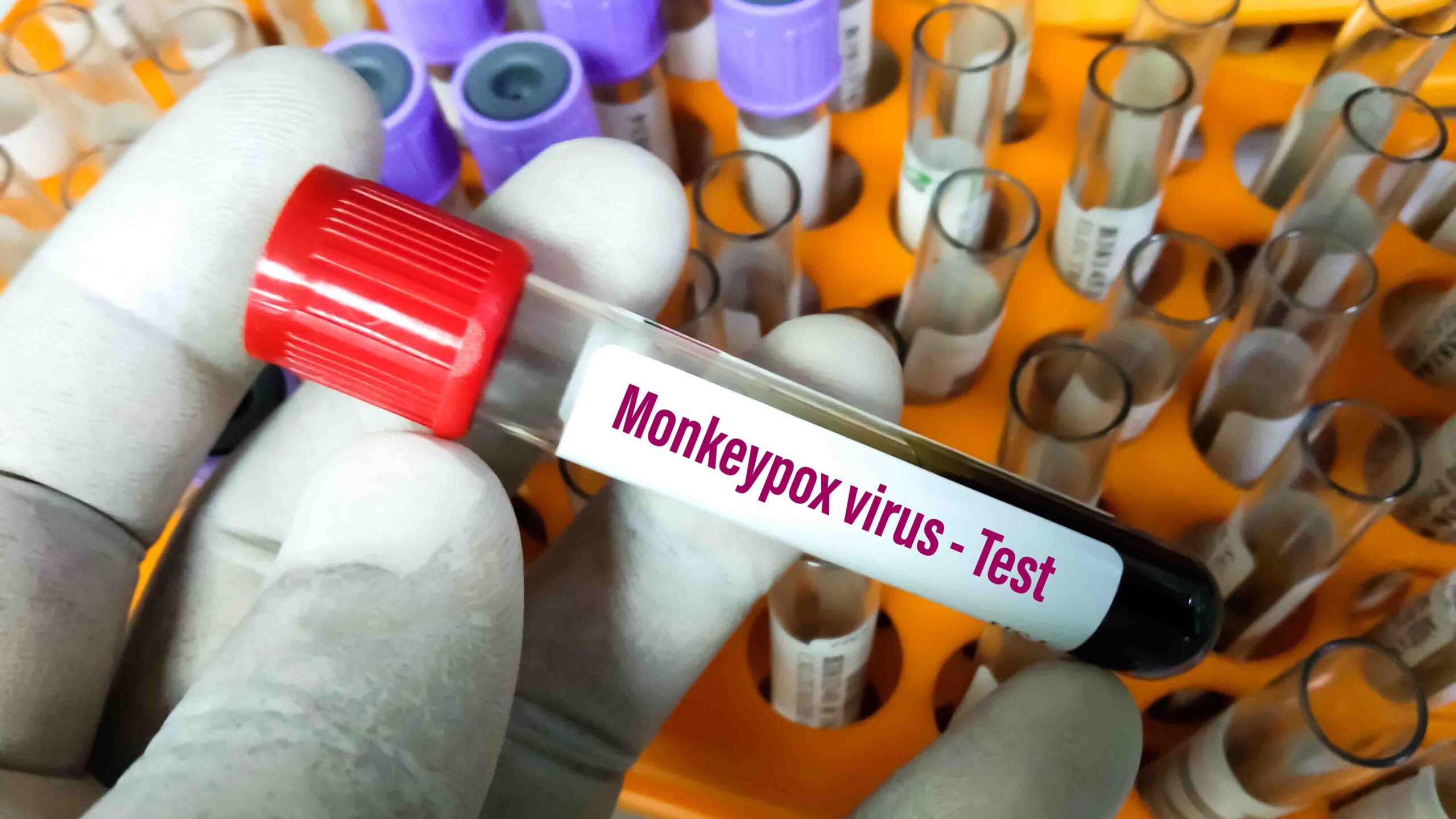 La OMS convoca a expertos para decidir si la viruela del mono es una emergencia