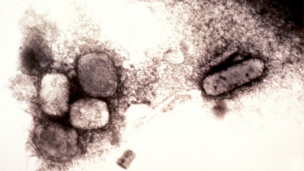 Viruela: Quién descubrió la vacuna