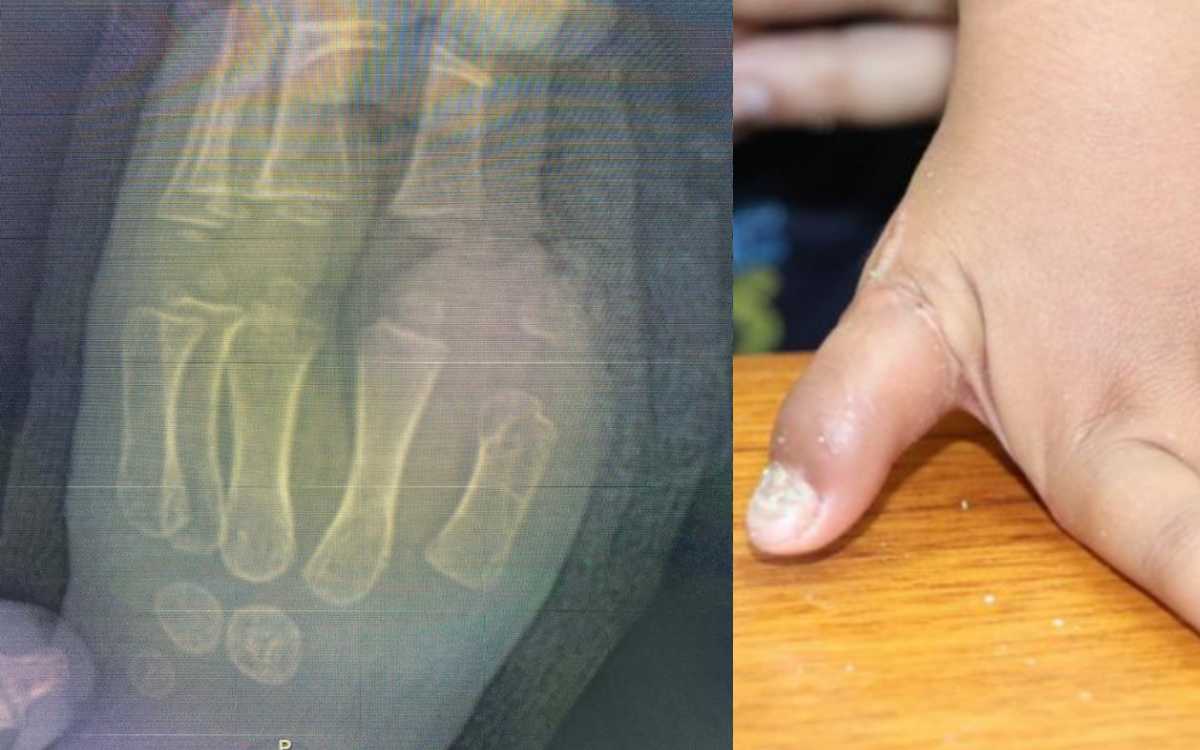 Cirujanos plásticos del IMSS reimplantan dedo pulgar a niño de 1 año tras sufrir accidente