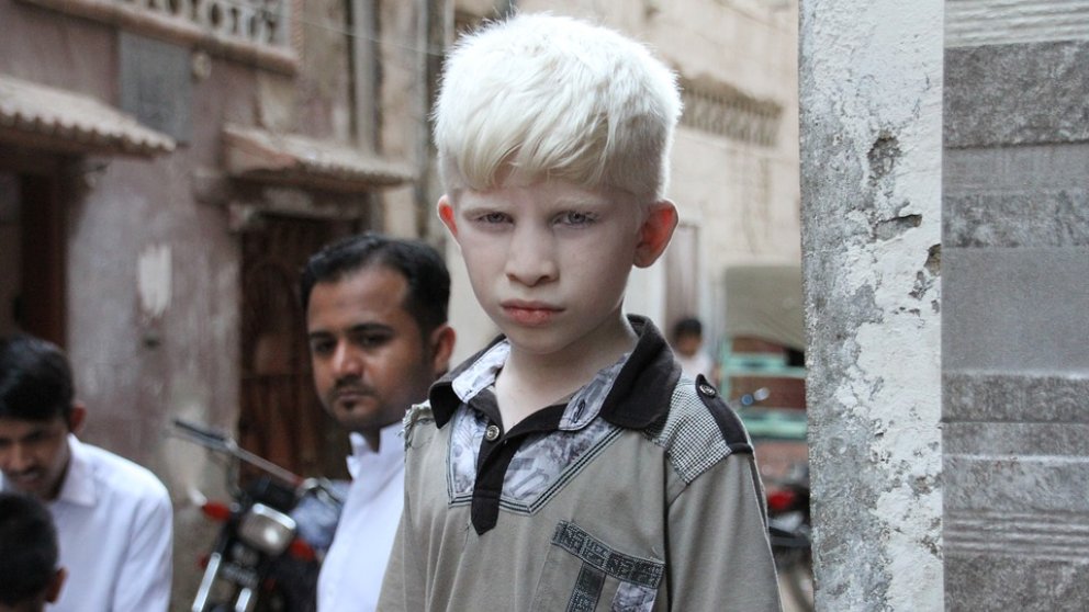 Por qué hay personas albinas