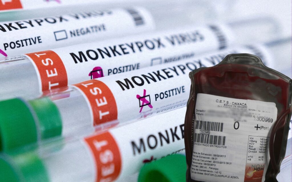 OMS no tiene pruebas de que la viruela del mono se transmita por transfusión de sangre