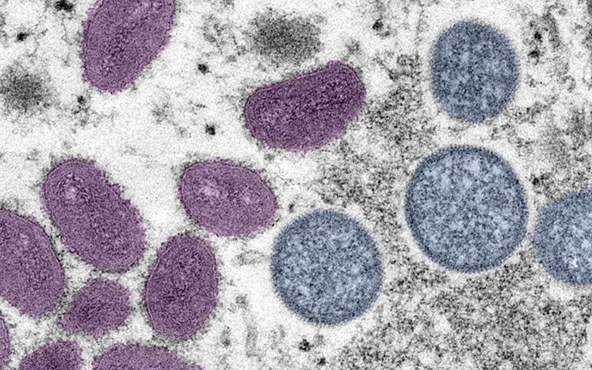 Viruela del mono puede ser mortal para quienes tienen VIH o un sistema inmune débil: estudio