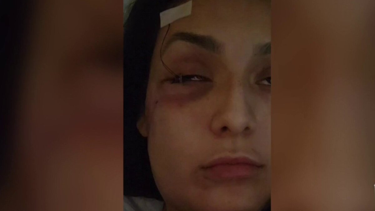 Mujer de San Antonio relata la pesadilla que vive tras ser baleada en la cara