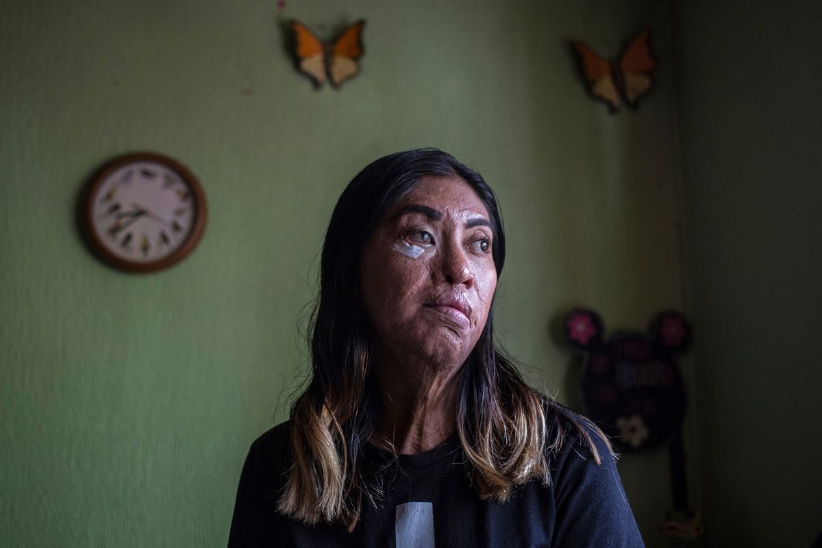El Senado aprueba castigar hasta con 22 años de prisión los ataques con ácido en México
