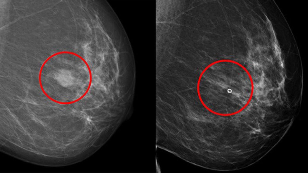 Ahora hay un nuevo método que identifica el  mejor fármaco para cada paciente con cáncer de mama