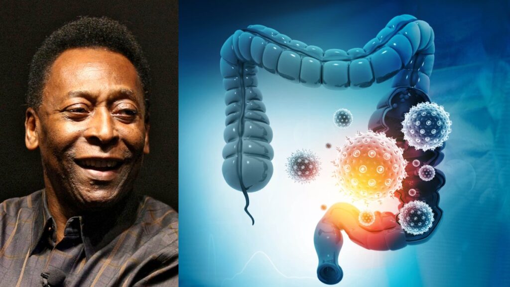 Los 6 síntomas que no debes ignorar del cáncer de colon, la enfermedad por la que murió Pelé