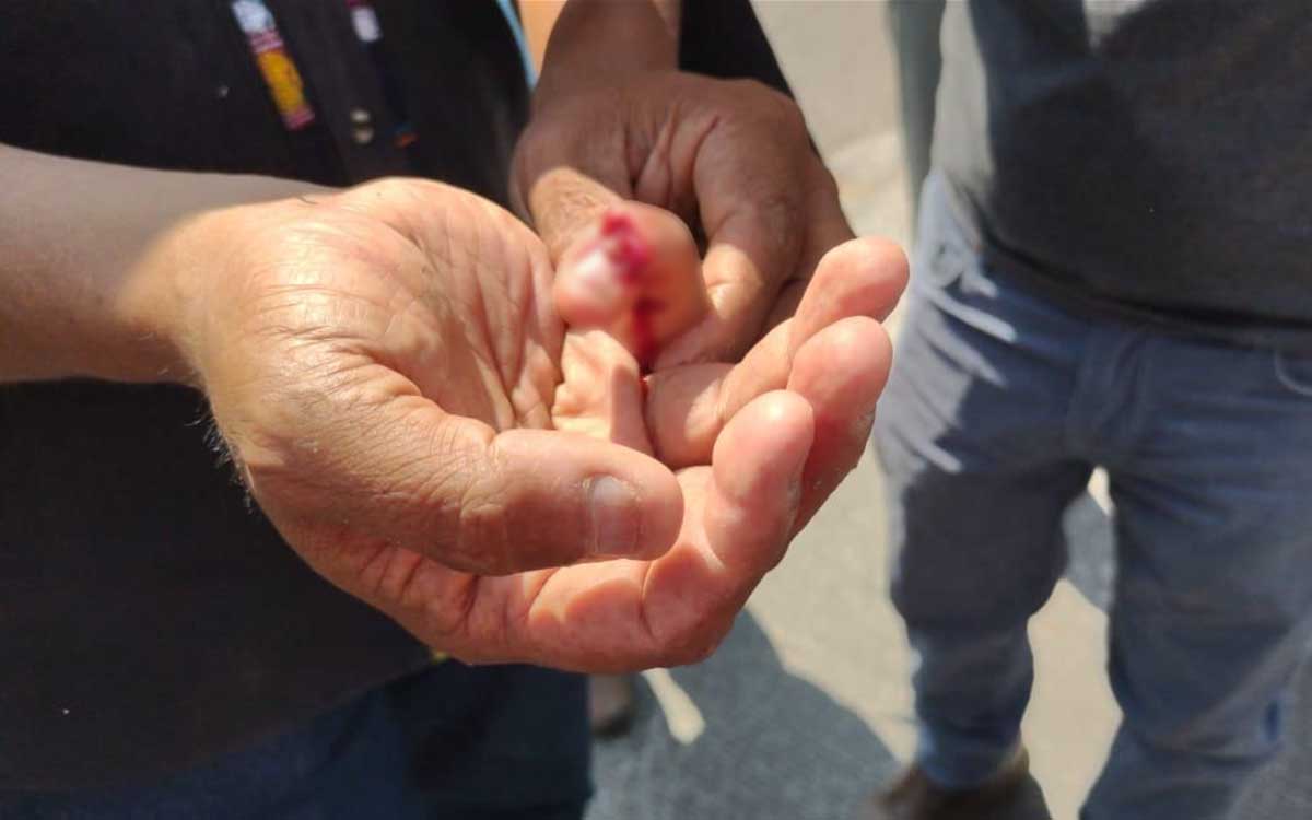 Amputan dedo a manifestante lesionado por seguridad del Congreso de Morelos