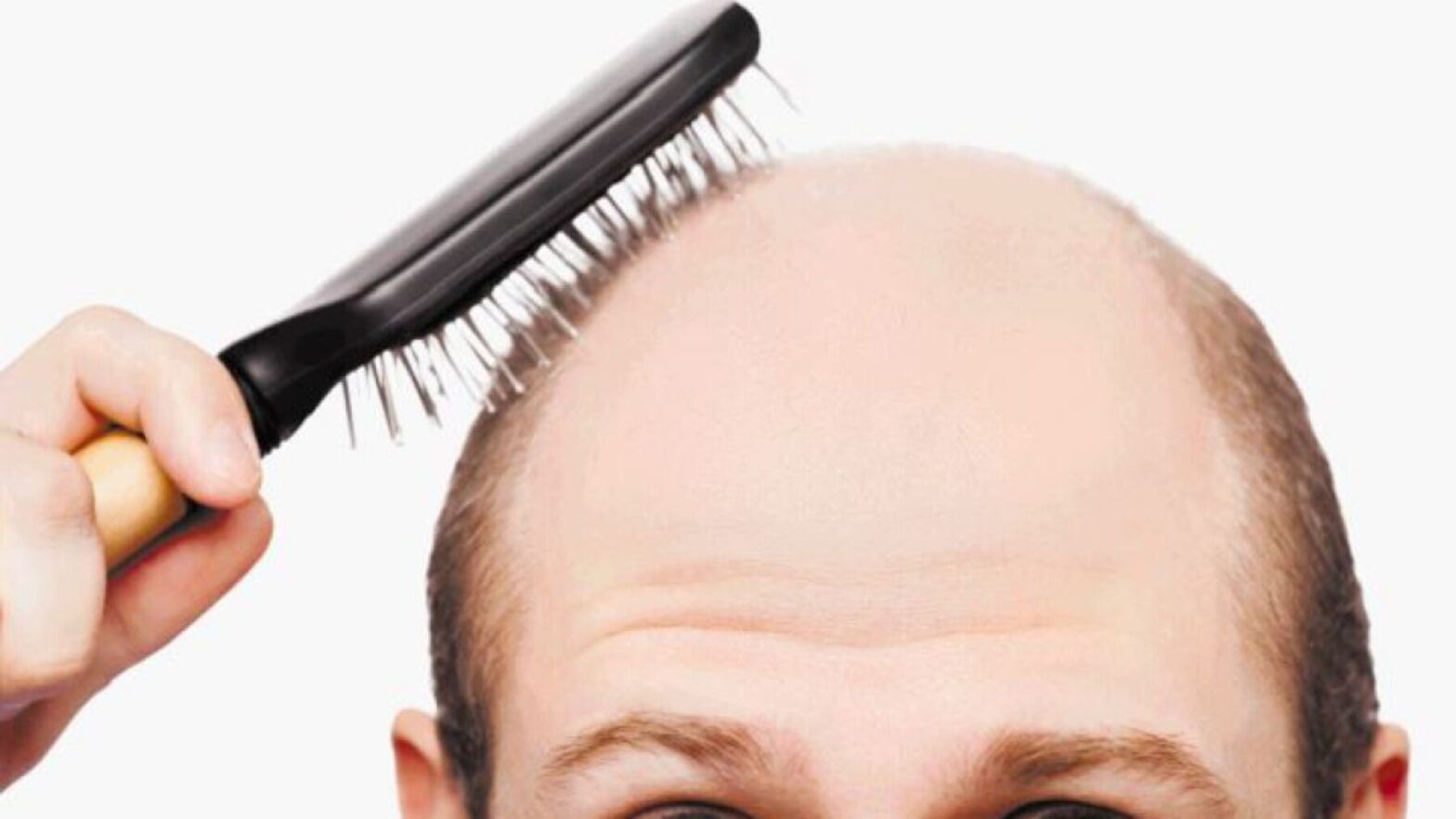 la increíble técnica que podría poner fin a la calvicie y regenerar cabello perdido