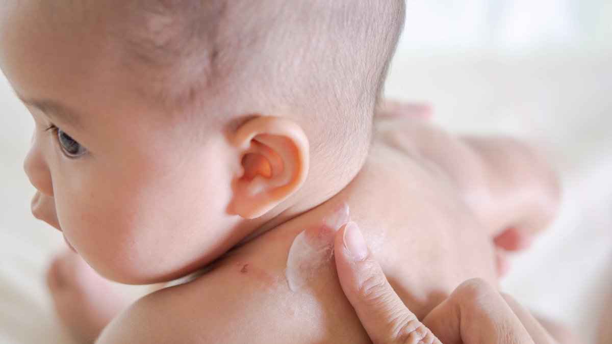 Estudio revela cuál sería la primera señal que tu bebé desarrollará alergias