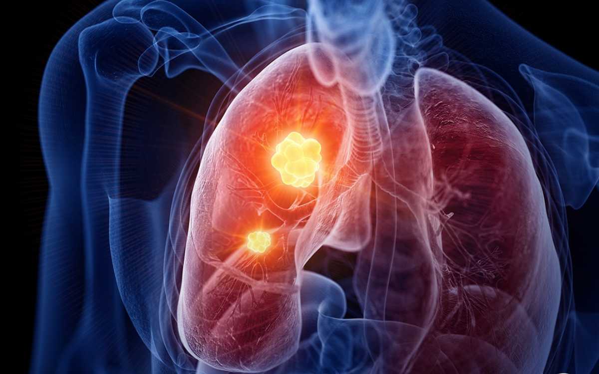 México registra más de 7 mil 500 casos nuevos de cáncer de pulmón cada año: OMS